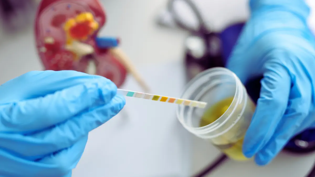 Échantillon d’urine rougeâtre évoquant une hématurie, bilan rapide au Cabinet d’Urologie Majorelle à Marrakech