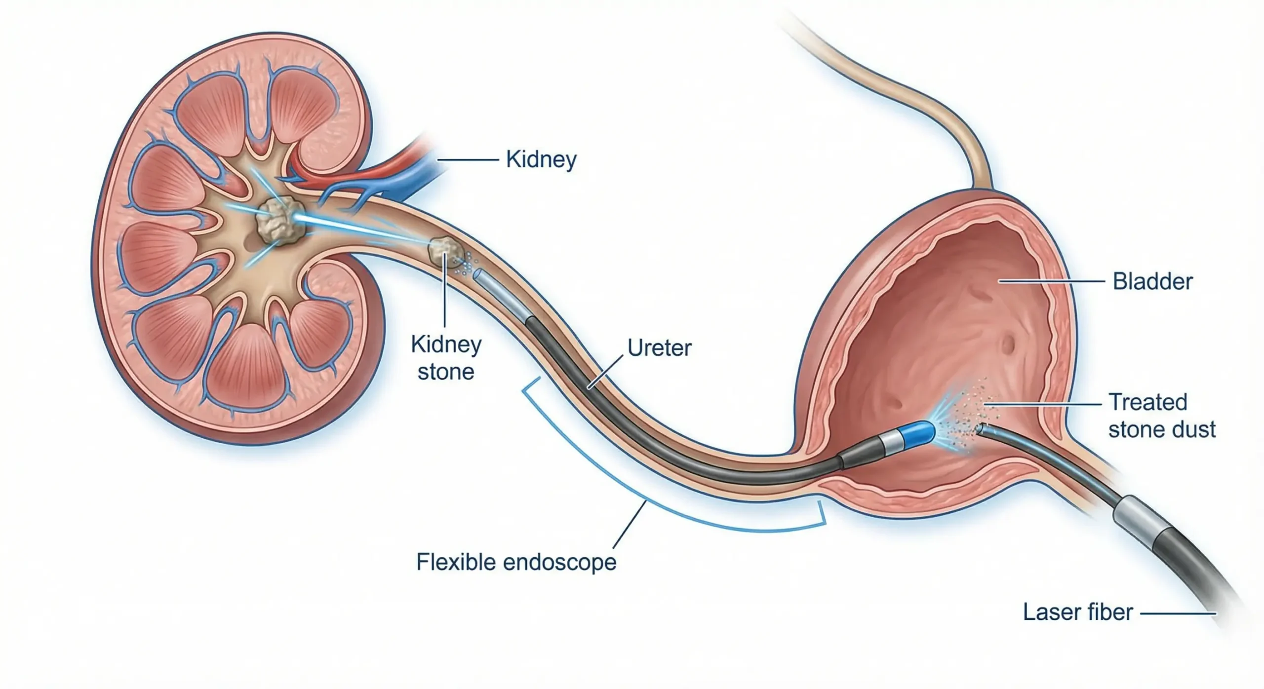 Schéma d’une urétéroscopie au laser à Marrakech pour traiter un calcul urinaire par voie naturelle.